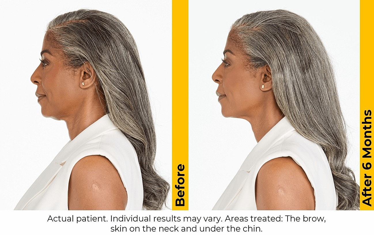 Before and after cosmetic treatment comparison.